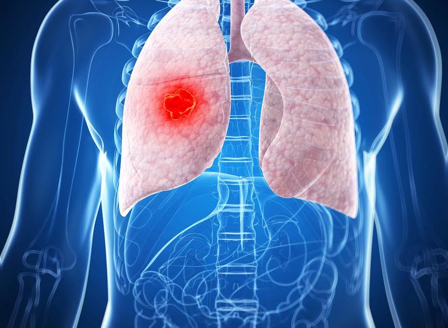 Todo lo que debe saber sobre el cáncer de pulmón