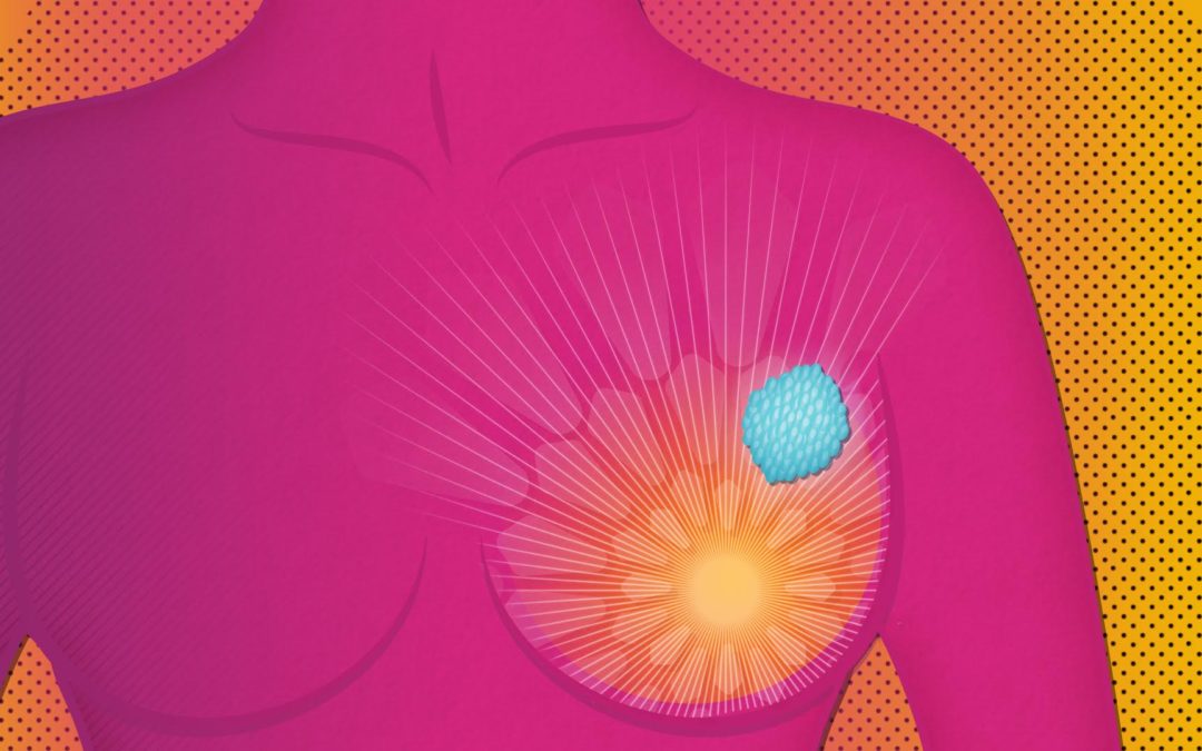 Cáncer de mama impactó la vida de 2.3 millones de pacientes en el 2020