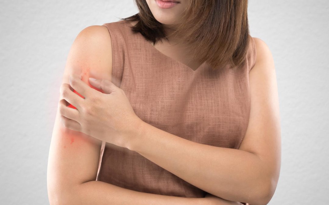 Dermatitis Atópica: Los síntomas y lesiones visibles de la enfermedad