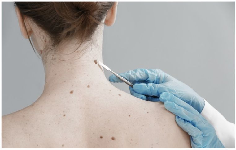 Dia Mundial contra el cáncer de piel: La radiación no se ve, pero deja huella